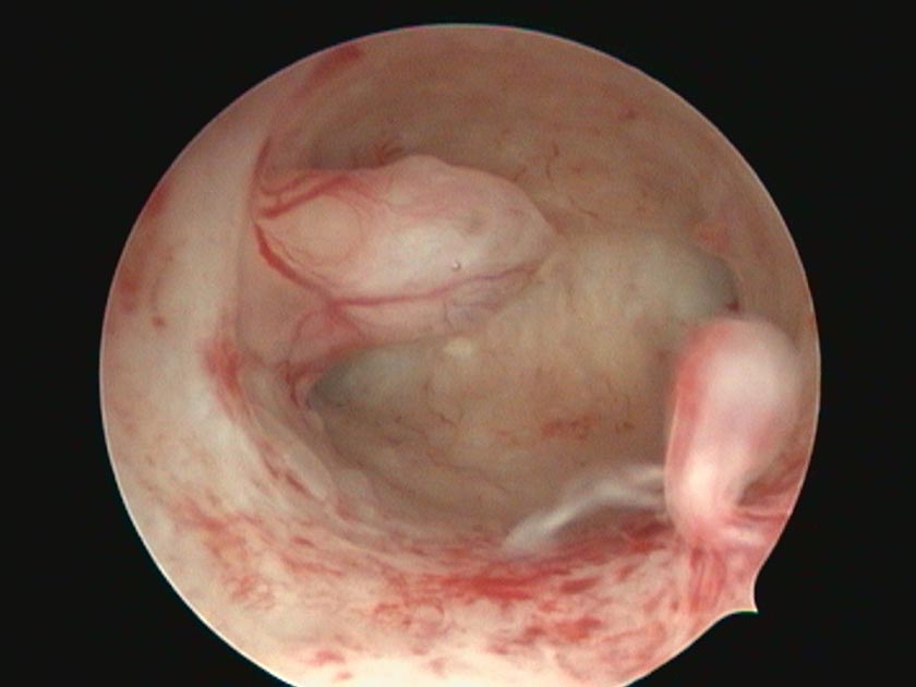 Hysteroscopy image of the uterine cavity with endometrial polyps