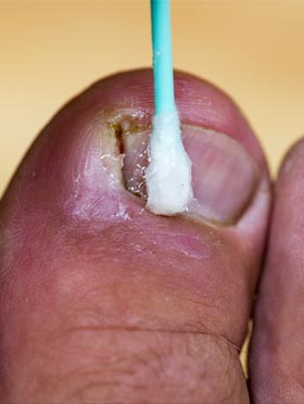 Care of an infected ingrown toenail. PHOTO: ADOBE STOCK