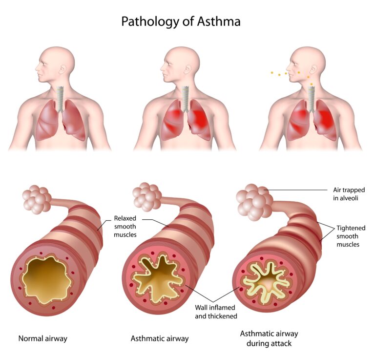 Asthma: Thinking SMART, using AIR and making a difference – Kaitiaki ...